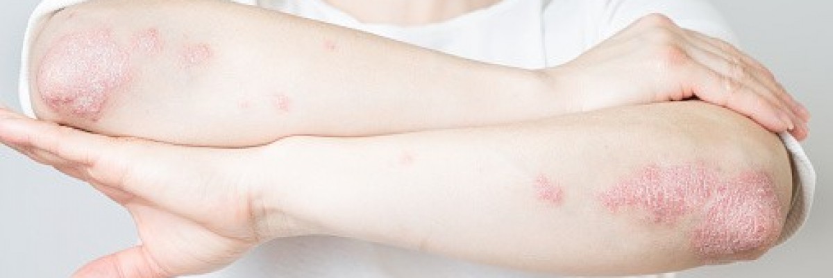 Dermatoloji 1 : Psoriasis