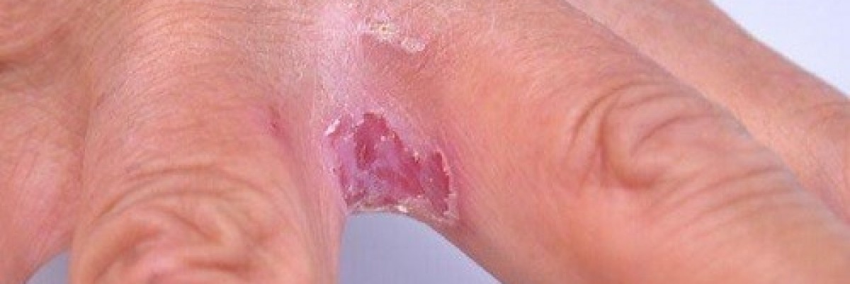 Dermatoloji 2 : Mantar Enfeksiyonu