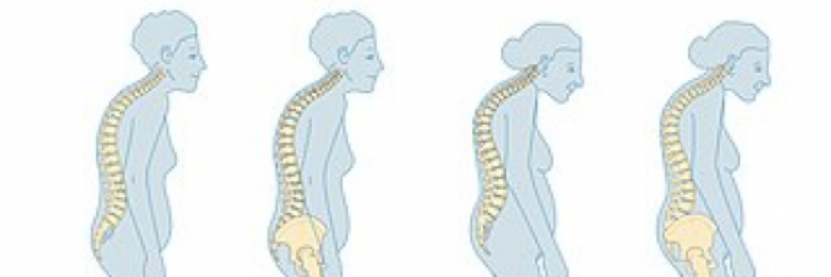 Bir Halk Sağlık Sorunu: Osteoporoz